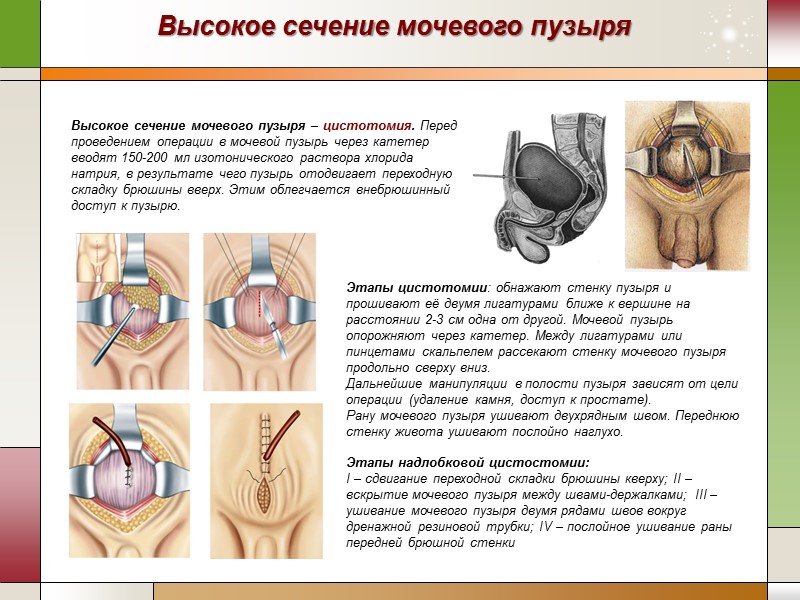 Высокое сечение мочевого пузыря Высокое сечение мочевого пузыря – цистотомия. Перед проведением операции в